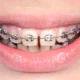 metal braces in Bakersfiled