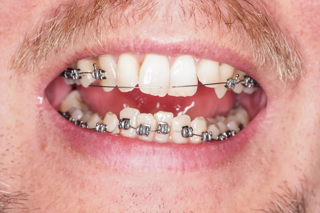 frontal image of a man's braces with broken brackets