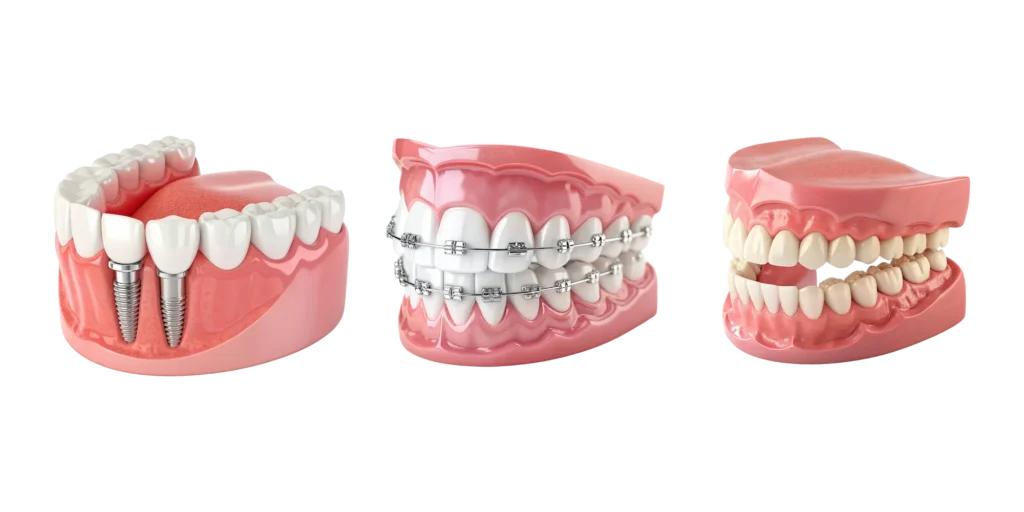 Dental implant braces and teeth models 